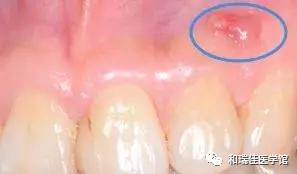 俩牙中间牙龈反复起脓包怎么回事,牙龈反复长脓包怎么消除最快方法