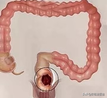 什么情况要做直肠指诊,不需要做直肠指检的有哪些疾病