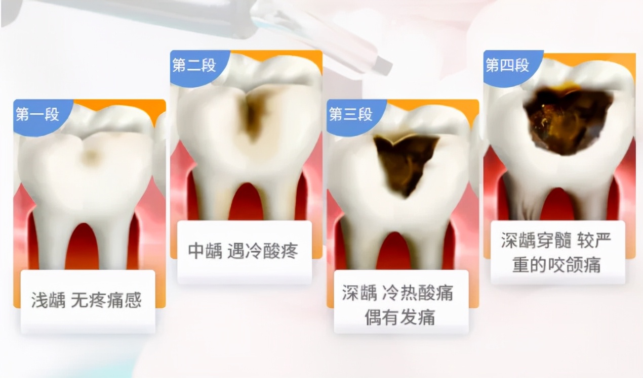 关注口腔爱在植得|补牙≠填洞，第一次补牙你应该知道的事