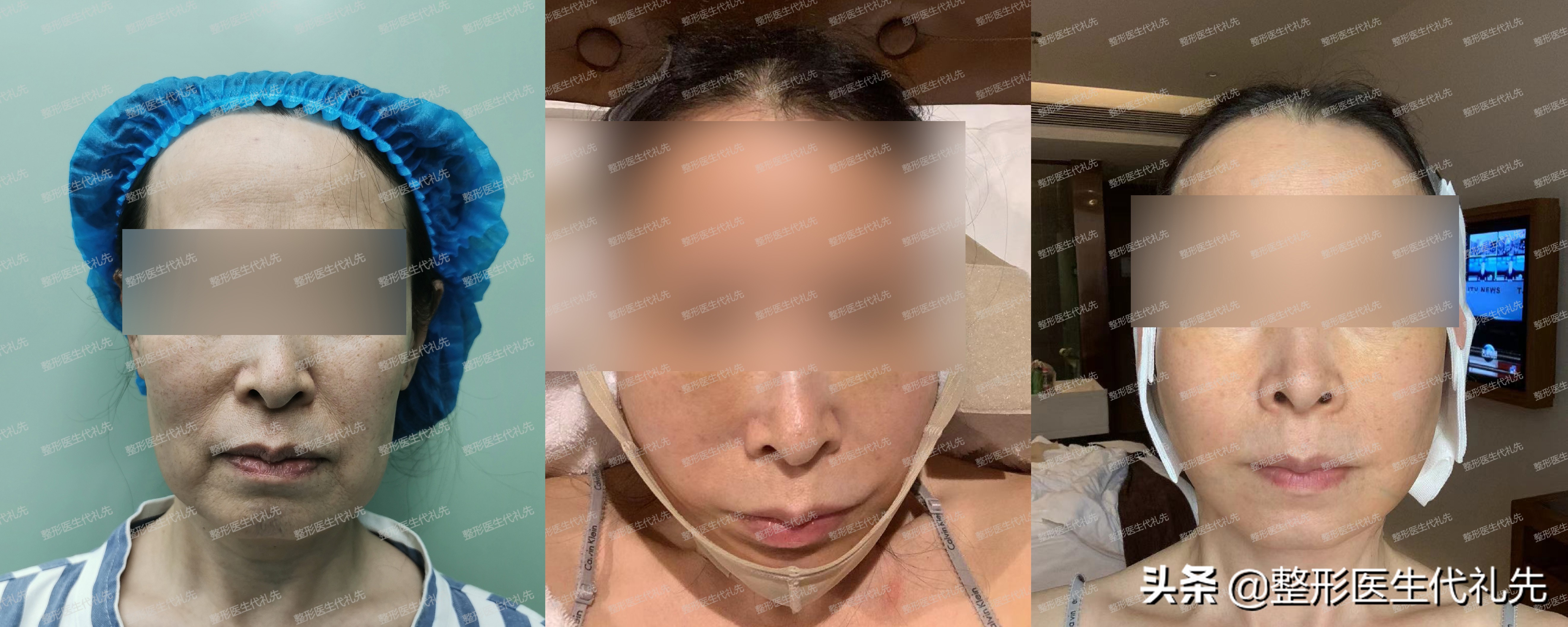 拉皮五天没消肿法令纹还在,拉皮手术可以去除法令纹吗