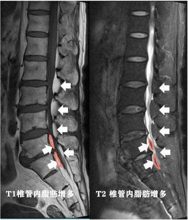 脂肪瘤长得比较快是因为恶变了吗,长了一个脂肪瘤必须赶紧做手术吗
