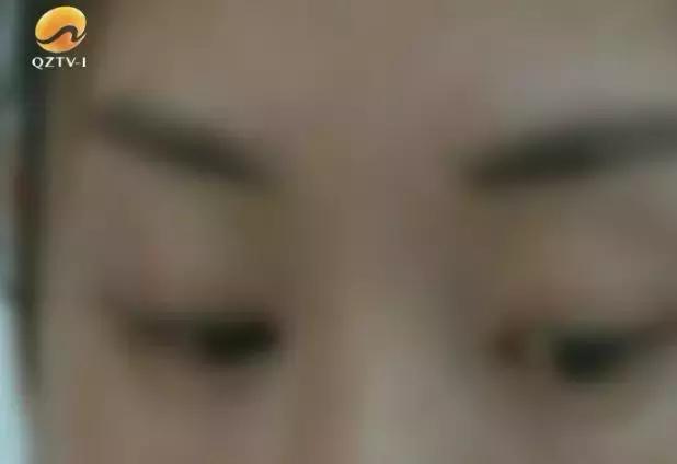 泉州这位女士消费1万多美容，却出现面瘫、双眼模糊……