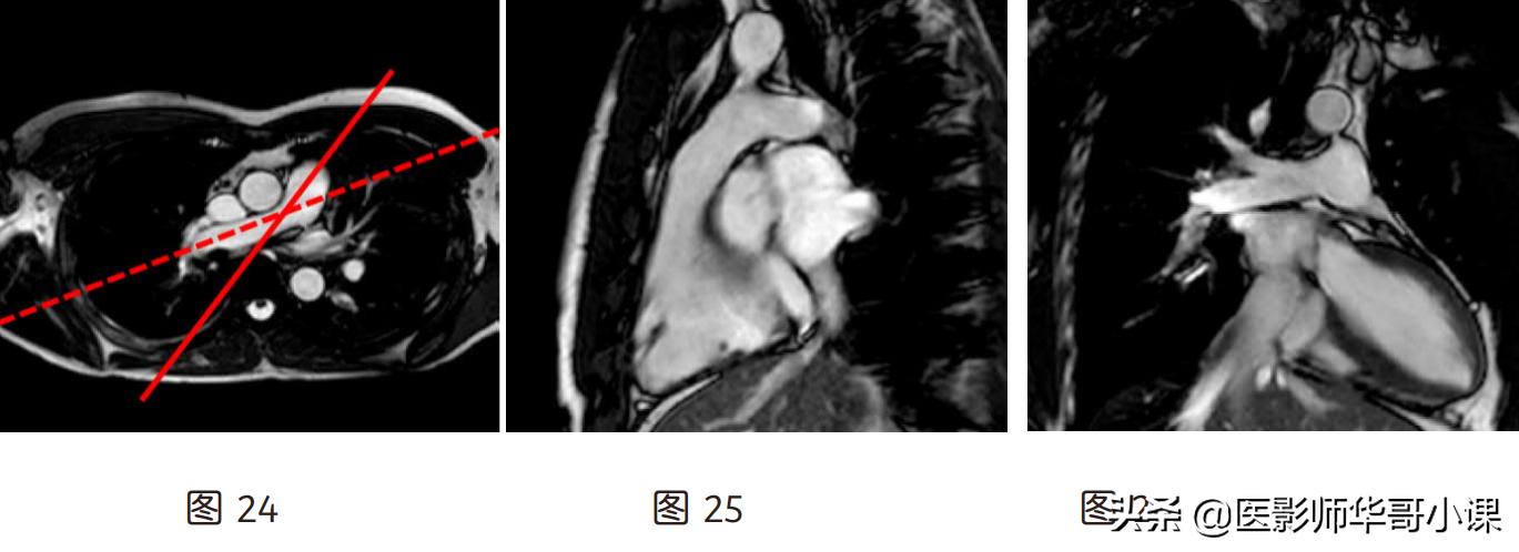 心脏mr增强扫描讲解,磁共振心脏扫描标准切面
