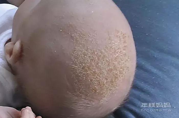 头上有硬硬的头皮屑想抠下来,头上长凸起的疙瘩抠下来像头皮屑