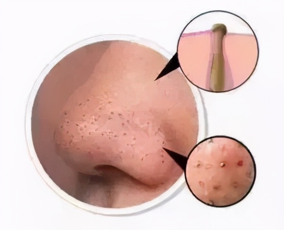 宋威龙、赵露思皮肤管理失败？毛孔粗大怎么办-四步改善毛孔粗大