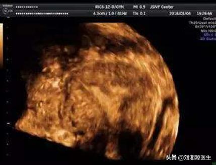 免疫治疗不良妊娠的方法,宫腔粘连合并妊娠