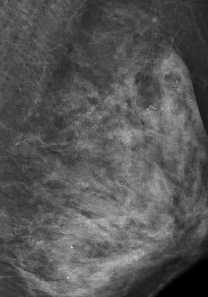 乳房按摩导致乳腺受伤,乳房按摩的不良后果