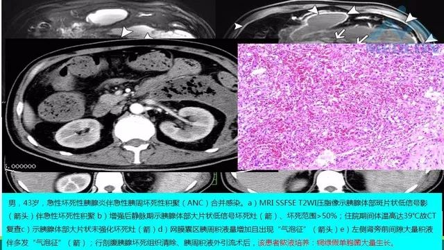 急性胰腺炎的护理措施,急性胰腺炎影像与临床