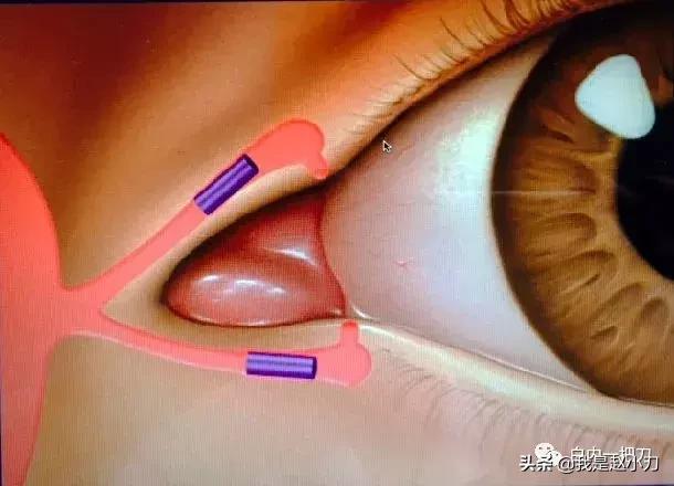 干眼症科普简短,七叶洋地黄双苷滴眼液治疗干眼症