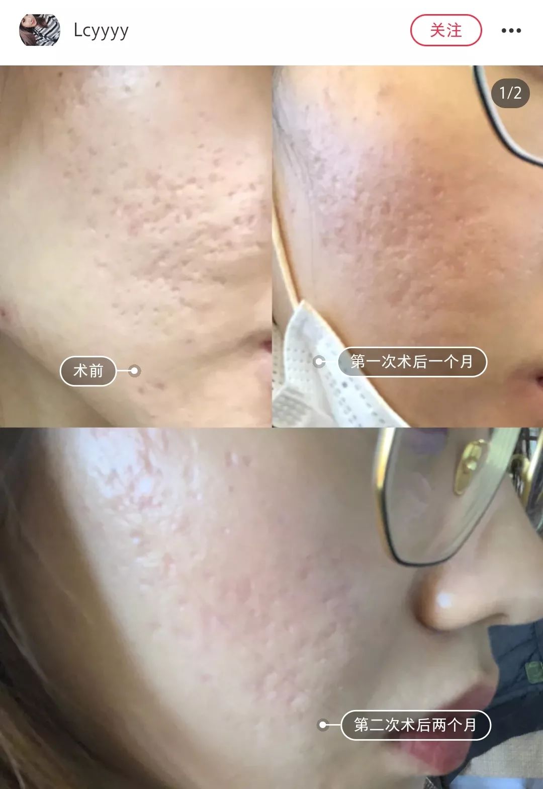 挤痘进了ICU，连下两次病危通知？这痘痘到底还能不能挤！