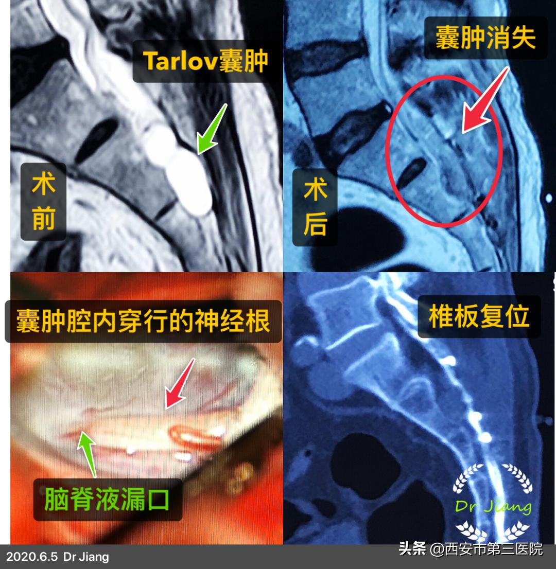 【医者解读】揭开“骶管囊肿”之神秘面纱，查出骶管囊肿都需要治疗吗？（手术病例+文献回忆）