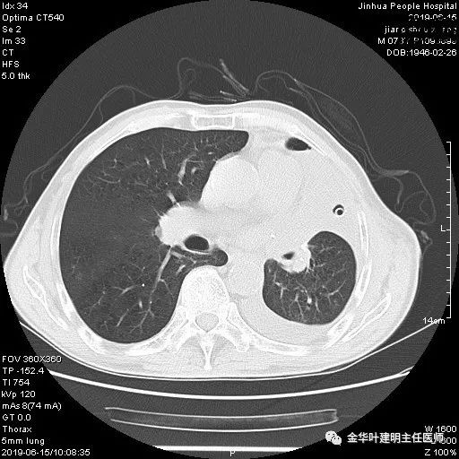 手术引起乳糜胸,有没有做了肺结节手术后是误诊的