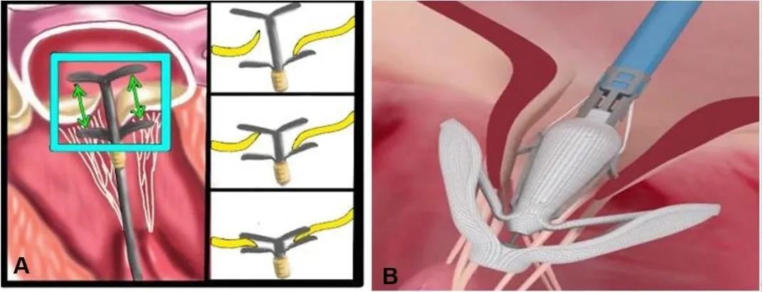 心脏“小门”关不严，经导管二尖瓣介入治疗，不开胸就换瓣
