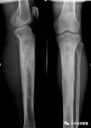 骨骼坏死最佳治疗方法,骨骼疾病治疗