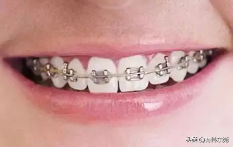 28.8元超声波洁牙！超值88折！让茶山人轻松实现...