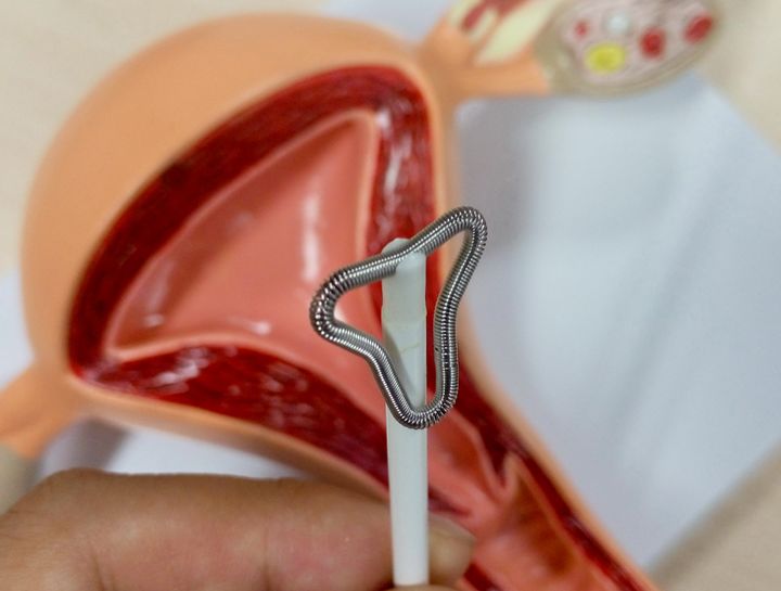 宫内节育器和节育环有什么区别,宫内节育器避孕环