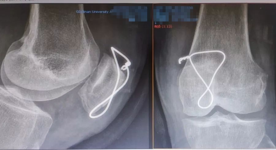 阿婆路边摔伤,阿婆摔倒了被扶起来