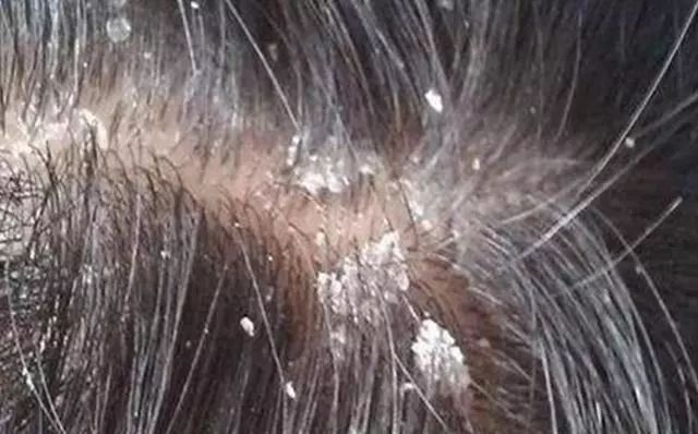 去屑洗发水专业测评,头屑克星去屑止痒洗发水干性皮肤