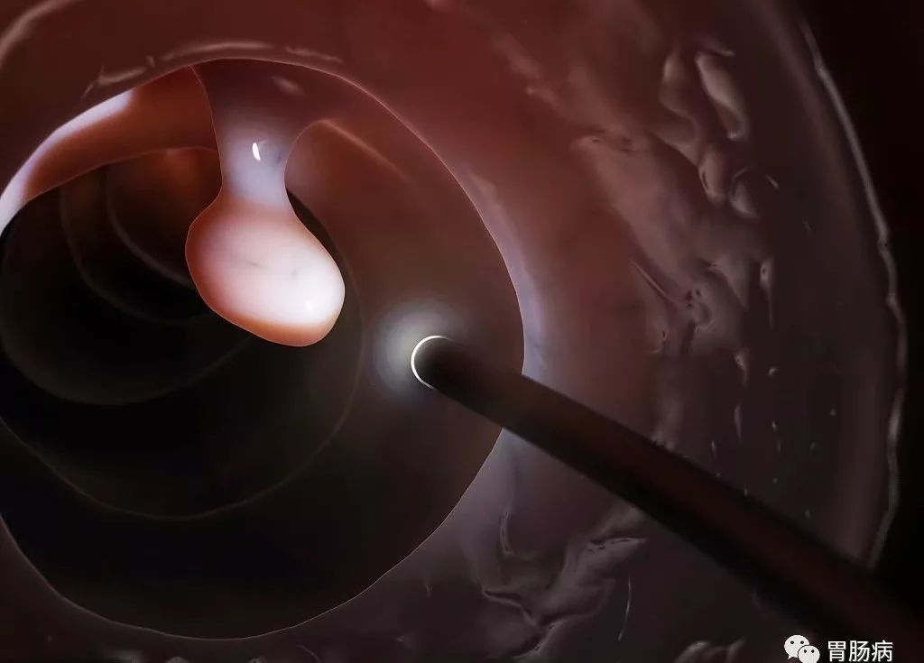 大肠息肉做完了还会长吗,大肠息肉切除了会复发吗