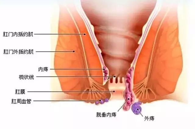 痔疮到底能疼多少天,痔疮到底能不能变小