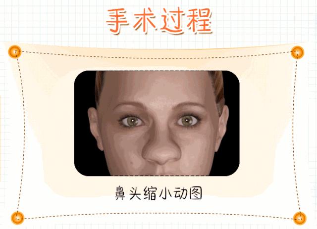 宽鼻子怎么变窄,鼻子大鼻翼宽怎么缩小