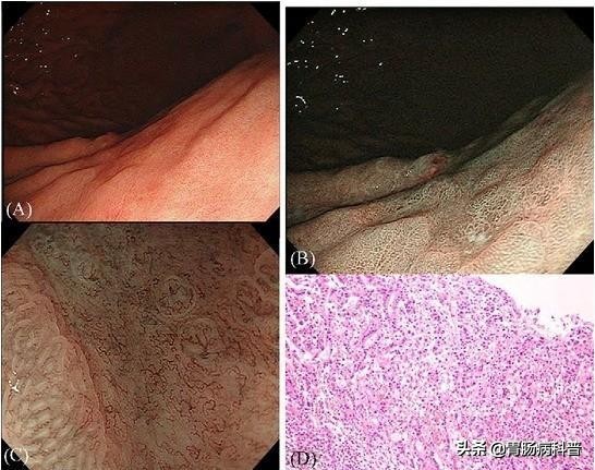 医生做胃镜检查时会看食道的吗,胃镜检查全过程视频消化内科检查
