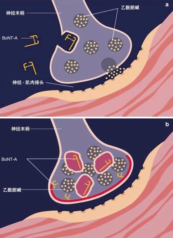 肉毒素打鱼尾纹范围大注射点图解,鱼尾纹肉毒素的危害和后遗症