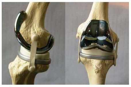 骨刺和骨质增生怎么治疗好得快,骨刺和骨质增生能吃骨刺平吗