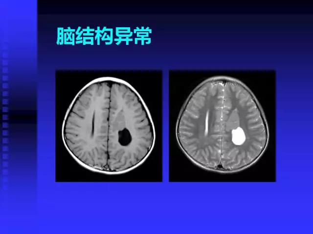 头颅mri读片视频教程,颅脑mri读片入门教程视频讲解全集