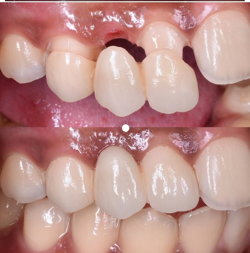 牙科全瓷冠与烤瓷冠有何区别,牙科中的临时冠和全瓷冠