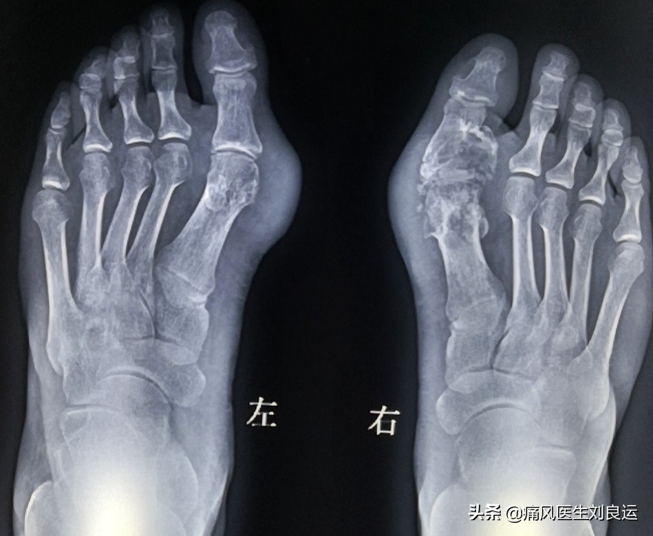 痛风发作大脚趾不能活动,痛风发作时只痛不肿不热为什么