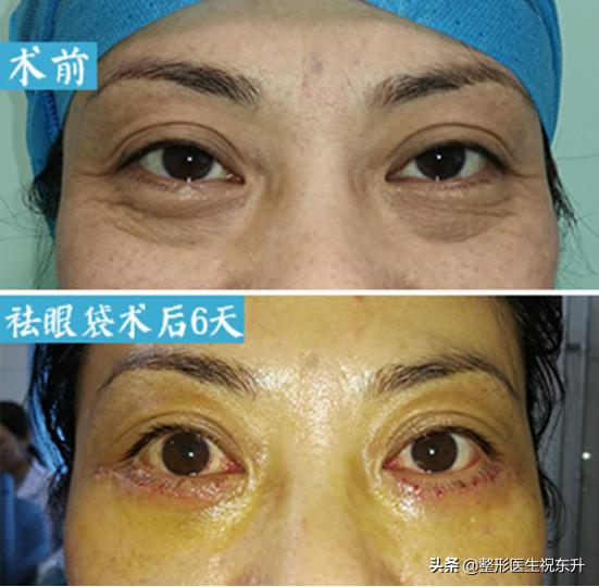 眼袋泪沟怎么解决最有效,眼袋有泪沟怎么治好得快