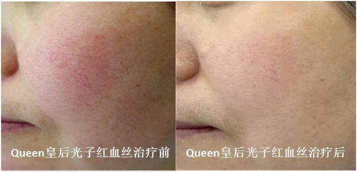 脸部脱毛和光子嫩肤可以一起做吗,油皮光子嫩肤护肤方法