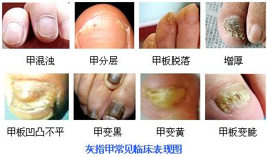 灰指甲清理过程,灰指甲能根治吗