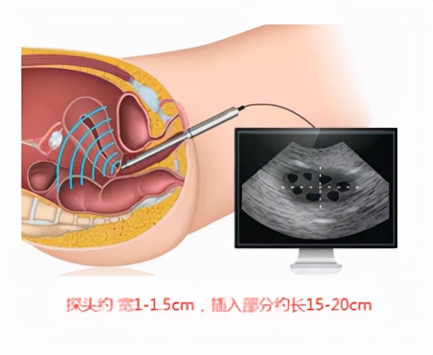害怕？紧张？脸红？你会拒绝做阴道B超检查吗？