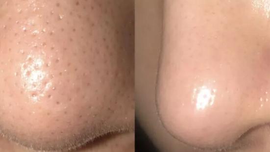 解决顽固黑头轻松去除草莓鼻,祛闭口粉刺草莓鼻