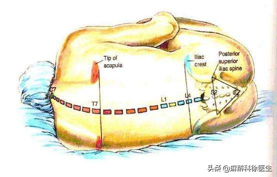 麻醉就是麻醉什么感觉,麻醉师讲的是什么