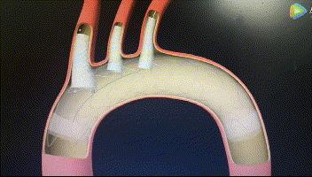 血管内再造血管？刀锋拆弹三开窗这种死亡率48小时达50%的疾病