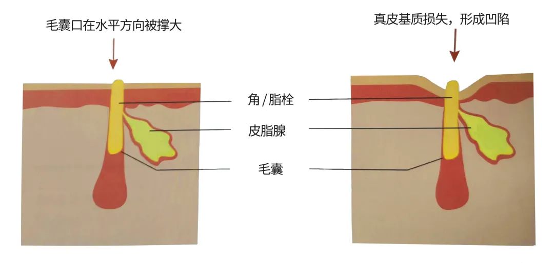 毛孔粗大最全攻略解决办法,毛孔粗大别担心记住这招全搞定