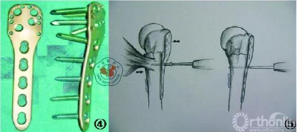 肱骨近端骨折内固定手术的经验与教训