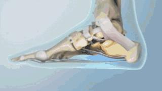 脚跟痛不要再让骨刺背黑锅了,足跟骨刺痛一招教你解决