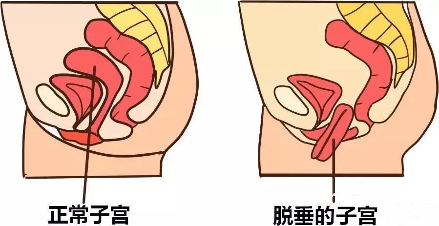 盆腔脏器脱垂的治疗方法,妈妈有妇科疾病