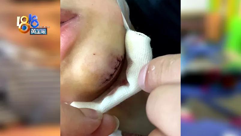 学轮滑摔破皮,儿童轮滑磕到下巴要多久恢复