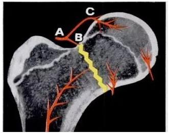 老年人肱骨骨折后该不该手术治疗,老人骨折的症状和治疗方法