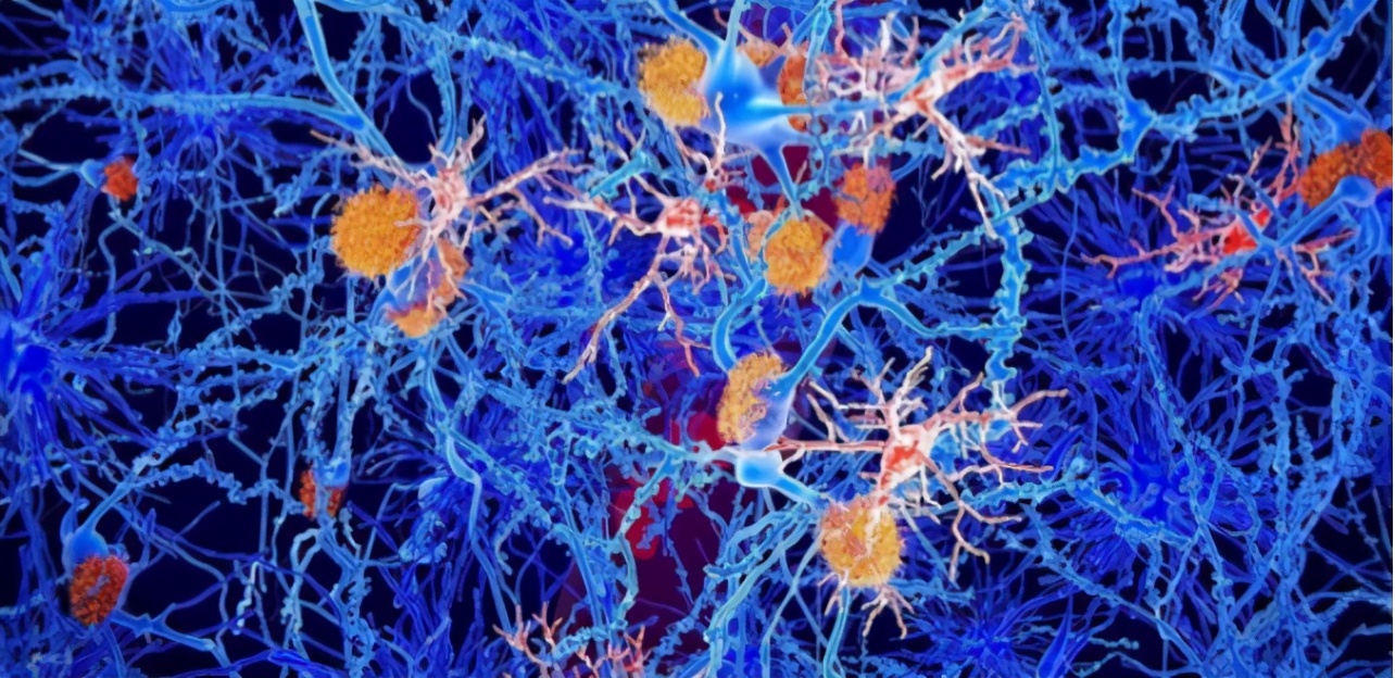 「全浸英语阅读」AlzheimersDisease阿兹海默症的微光