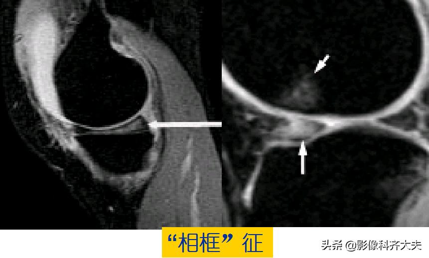 膝关节半月板损伤的磁共振,膝关节半月板病变的mri诊断与鉴别