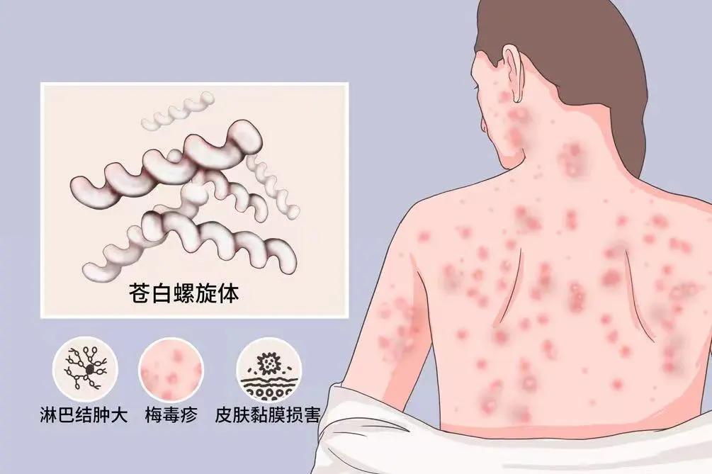 性病界的潜伏高手——梅毒