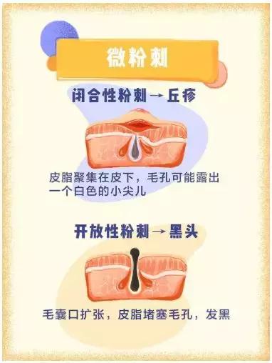 痘印痘坑痘痕去医院可以治好吗,防止痘坑的最好方法