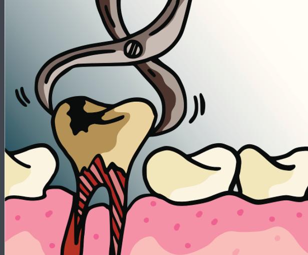 26岁男子拔智齿流血多日后离世,拔完智齿过几天又流血是什么病