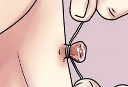 脖子上的小肉粒能揪掉吗,脖子上的小肉粒可以揪下来吗